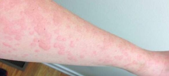 Le allergie cutanee sono un segno della presenza di parassiti nel corpo